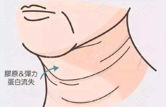 頸部拉皮手術(shù)維持多少年