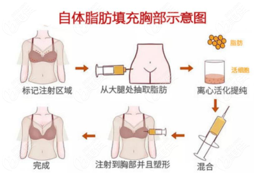 上海伊莱美李旭东医生脂肪丰胸手术过程和步骤