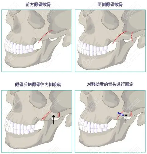颧骨双侧固定好还是单侧固定好236z.com