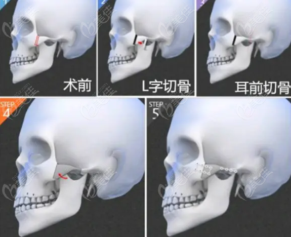 颧骨手术图示