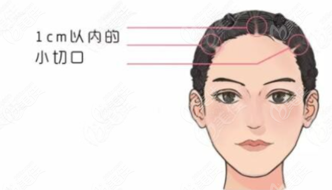 <!--<i data=20240703-sp></i>-->伯思立倪锋医生额头拉皮手术全过程