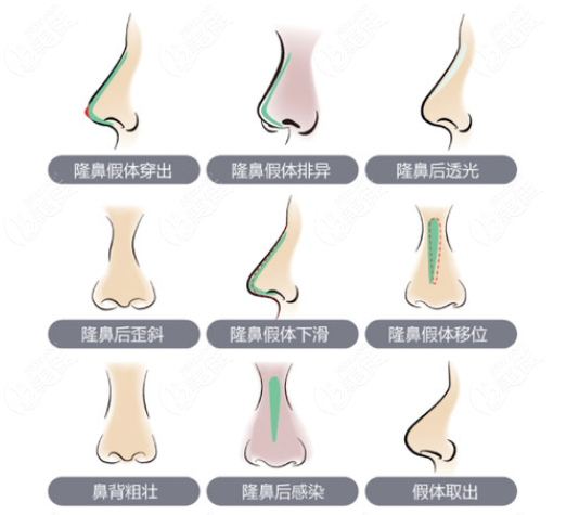 南京有名的修复鼻子的医生