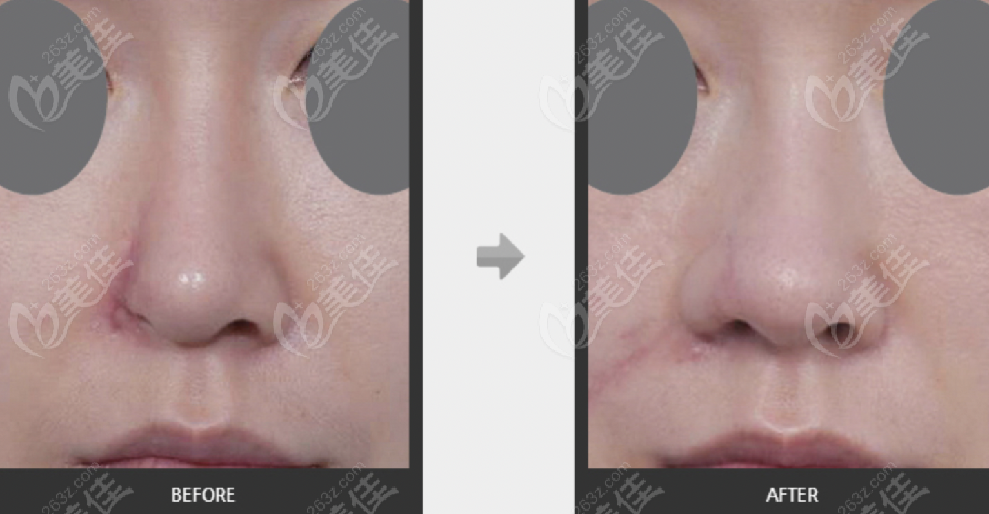 郑东学医生鼻翼缺损鼻子重建前后对比图片