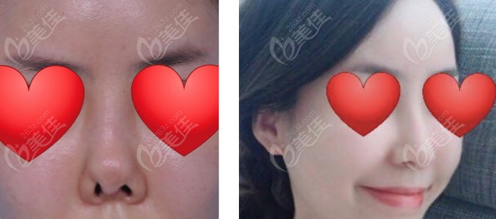 韩国整形医生郑冬学歪鼻+挛缩鼻修复前后对比照片