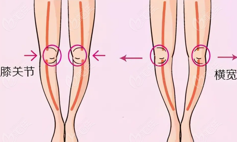 脂肪填充o型腿手术怎么样？