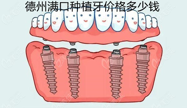 德州全口种植牙价格表