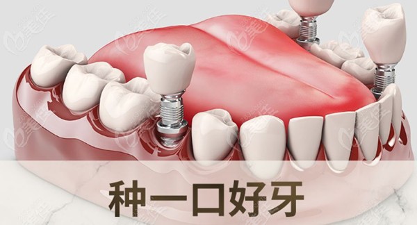 重庆牙卫士口腔医院种植牙优势236z.com