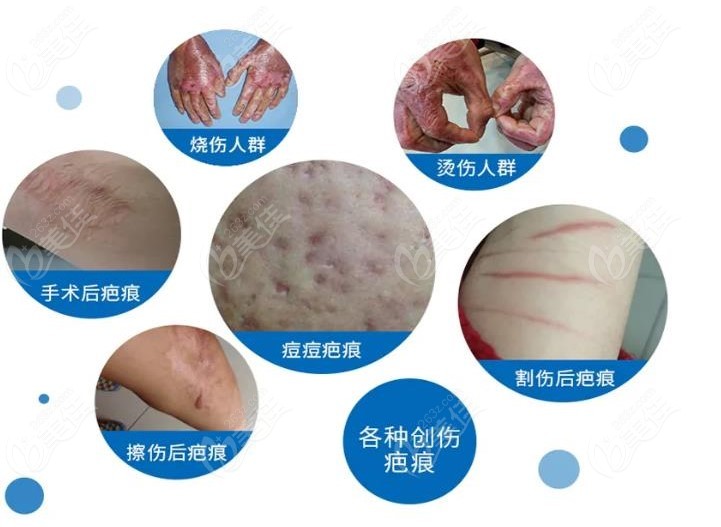 韩国疤痕整形医院排名前三修复疤痕种类m.236z.com分享