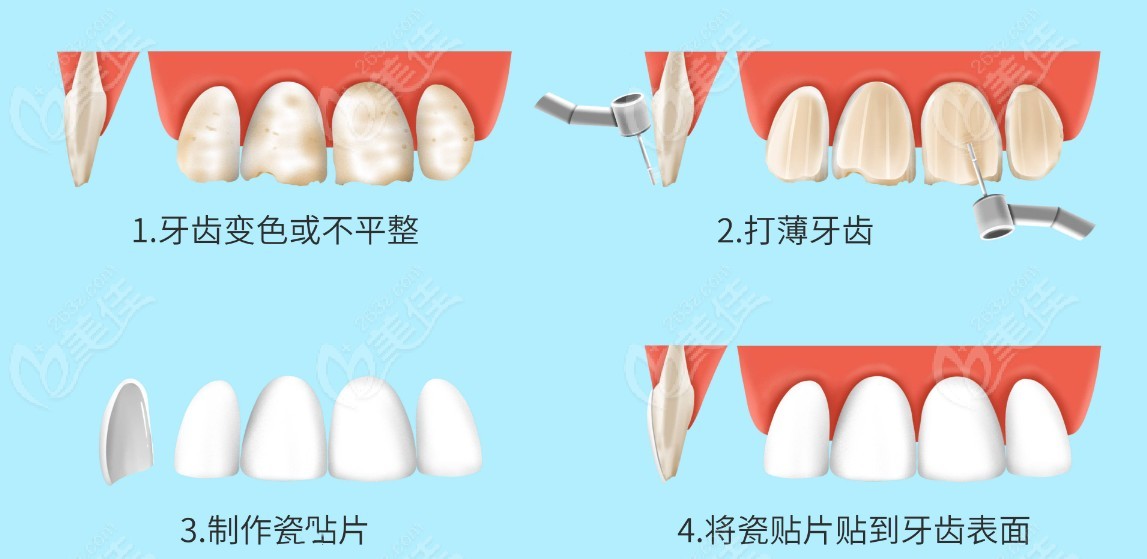 牙齿贴面的制作流程