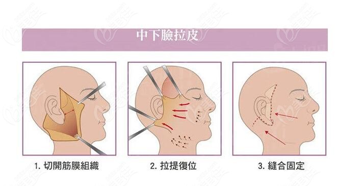 面部拉皮手术技术
