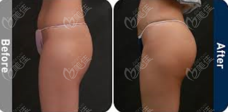 韓國(guó)Qline做提臀手術(shù)實(shí)例參考