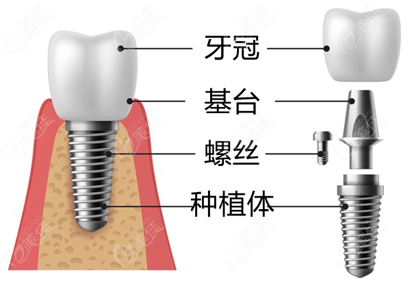 亮贝美口腔植体集采价格表236z.com