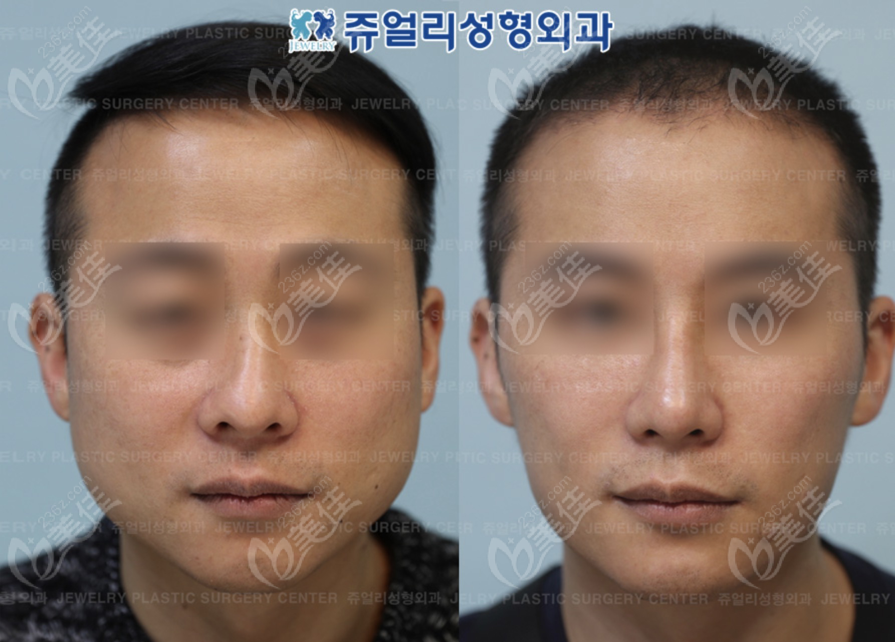 韩国菲斯莱茵李真秀轮廓手术前后对比,费用划算技术还好,面部吸脂-8682赴韩整形网