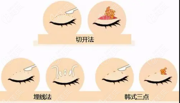 <!--<i data=20240703-sp></i>-->浦东新区开双眼皮怎么样