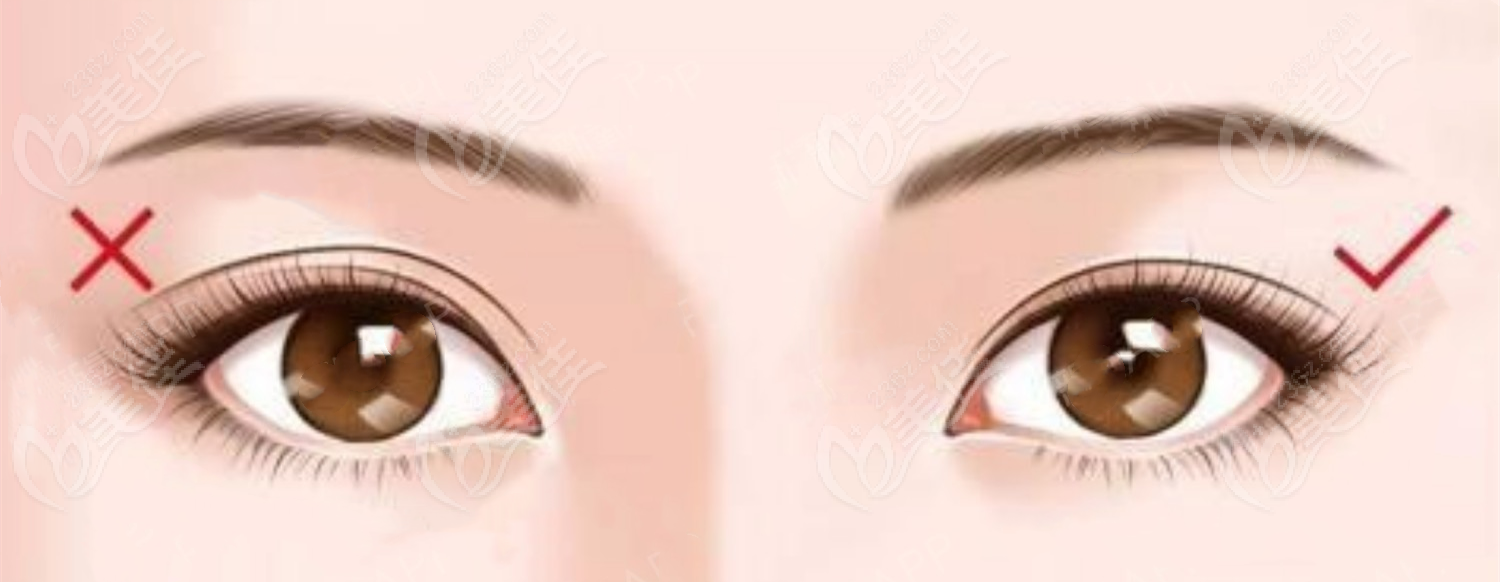 兰州时光贾治兰医生修复双眼皮例子m.236z.com