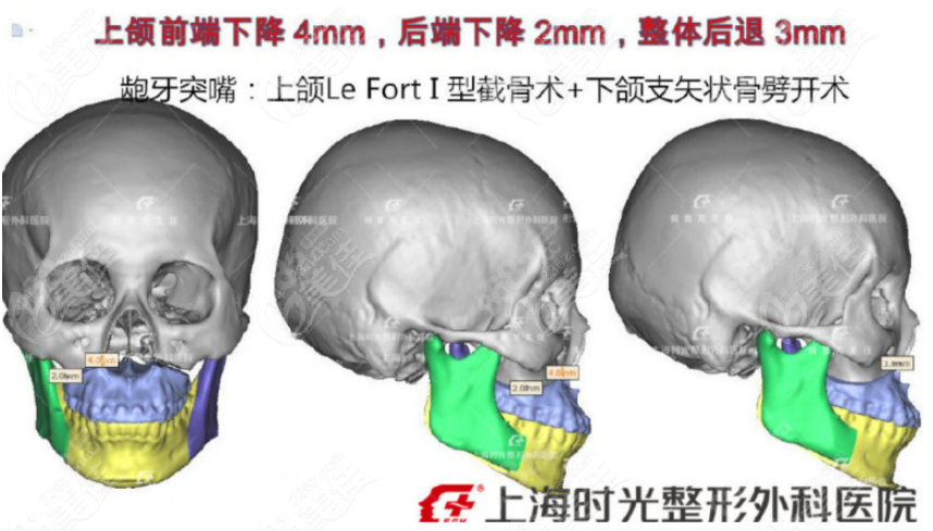 上海时光何晋龙做正颌手术有名