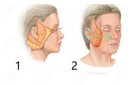 柳州仁美面部拉皮做得好236z.com