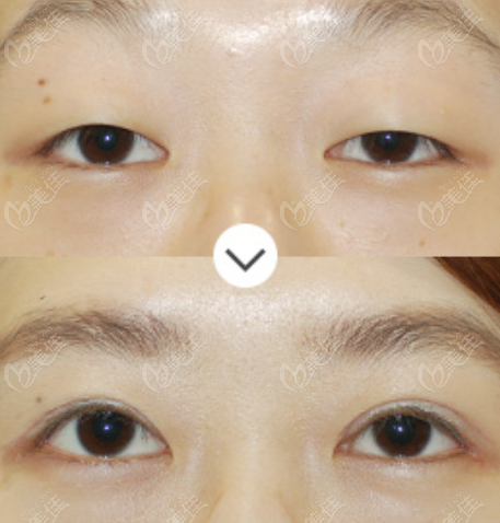 韩国世美朴相炫院长眼睑下垂实例参考（m.236z.com）