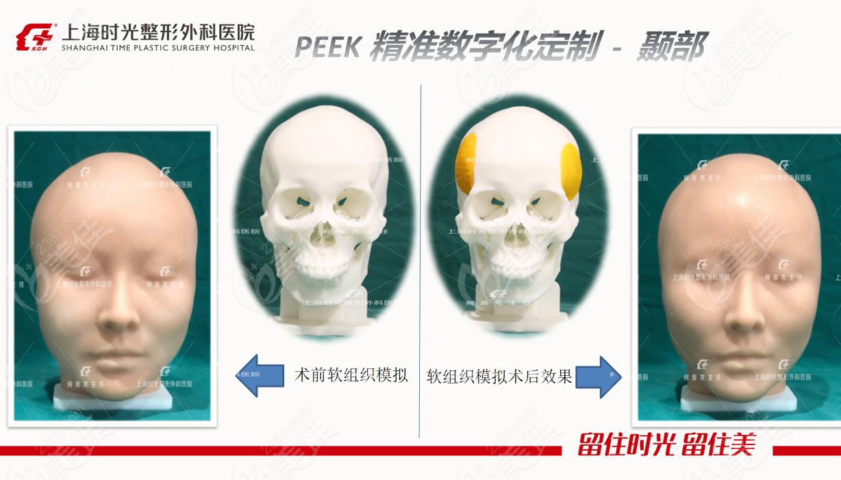 上海时光医院扁头变圆头整形手术前后对比图片