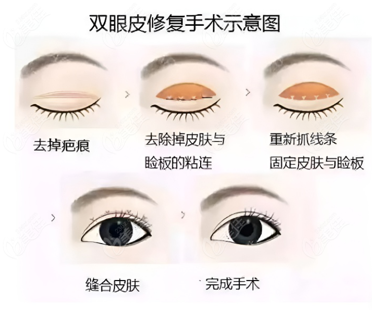 <!--<i data=20240703-sp></i>-->美姿<!--<i data=20240703-sp></i>-->医生双眼皮修复图片和真人实例