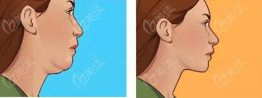 <!--<i data=20240703-sp></i>-->下頜緣提升醫(yī)院哪家好一點