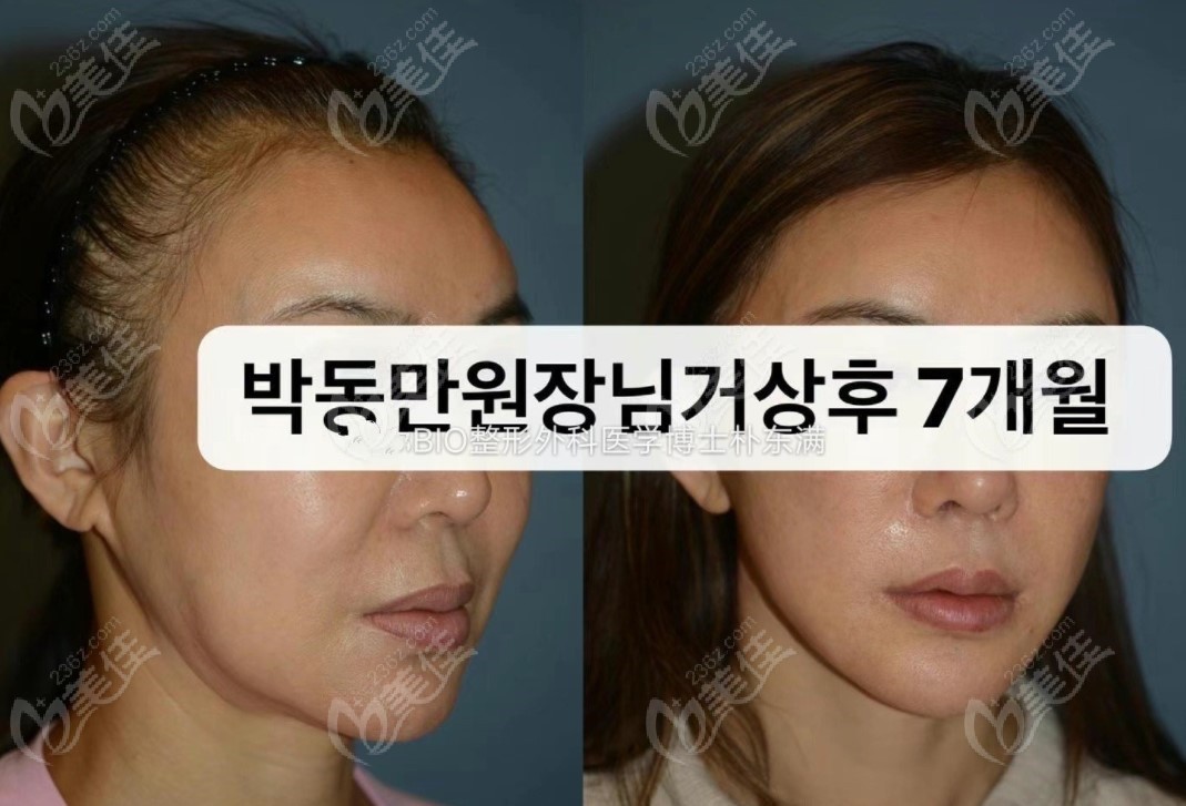 樸東滿那做的拉皮手術前后變化圖片