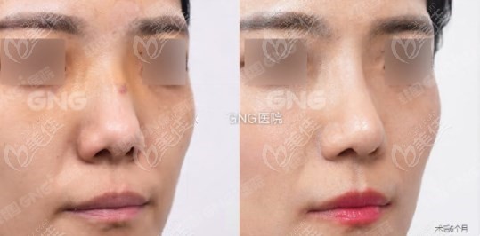 韩国GNG鼻骨骨折复位术前术后对比病例