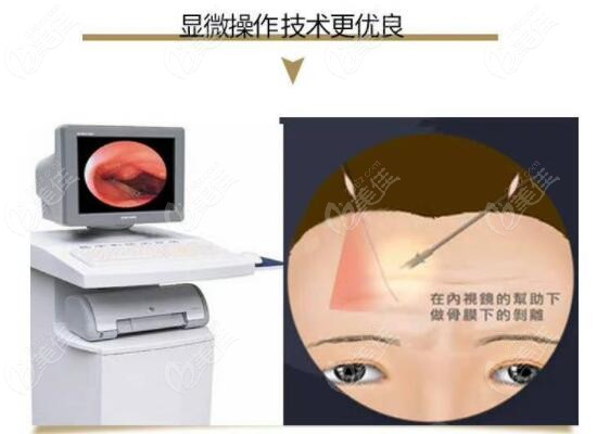 内窥镜额头提升术好不好m.236z.com
