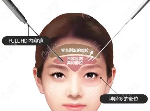 内窥镜额头提升术的好处