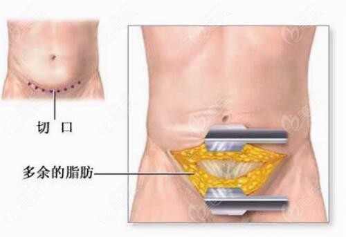 快速收紧肚子松弛的手术方法是腹壁整形