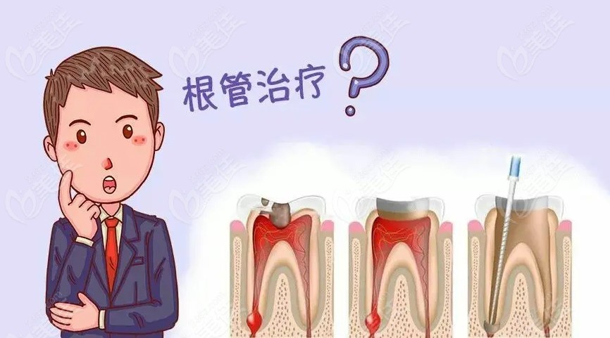 昆明根管治疗多少钱一颗牙？