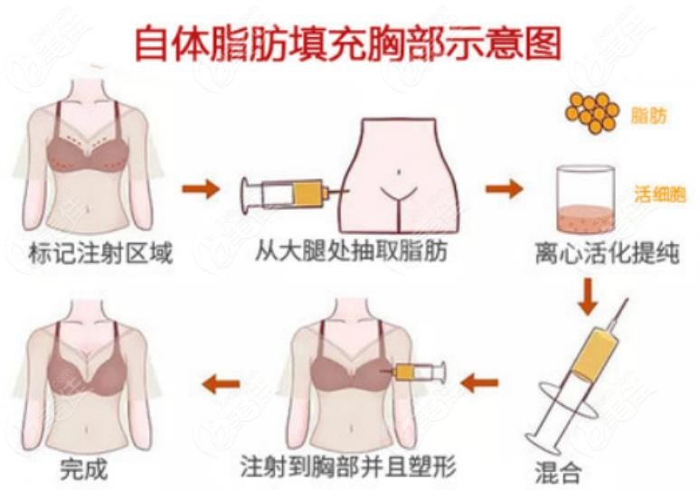 <!--<i data=20240703-sp></i>-->自体脂肪丰胸怎么样