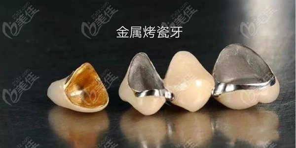 国产烤瓷牙冠多少钱一颗
