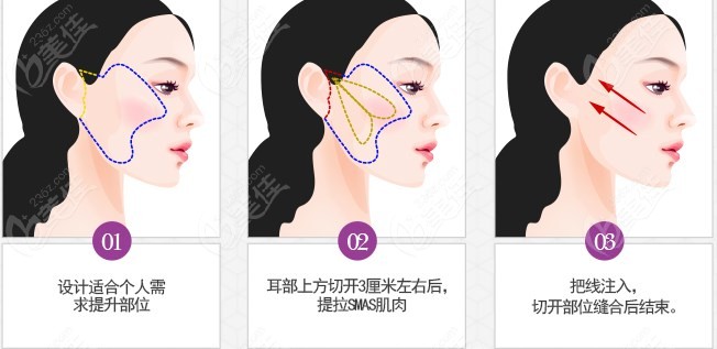 qmc提升術切口位置