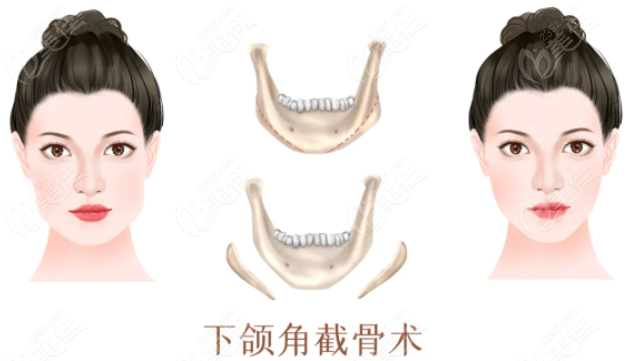 韩国玛博尔医院下颌角磨骨技术靠谱