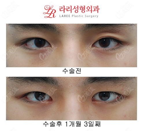 韩国来丽整形双眼皮改单眼皮+前眼角