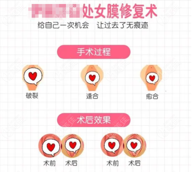 <!--<i data=20240703-sp></i>-->处女膜修复私密整形价格表