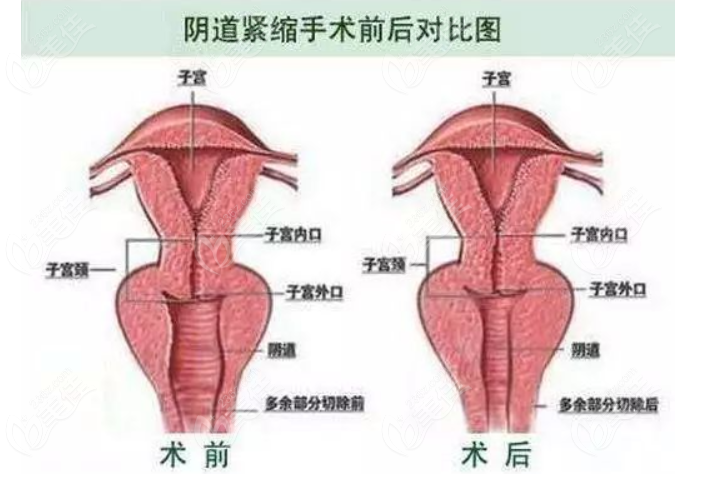 <!--<i data=20240703-sp></i>-->阴道整形价格表