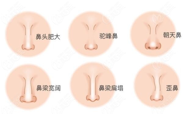 武汉隆鼻医生可以改善的鼻型多