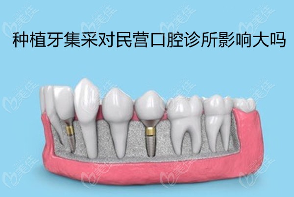 种植牙集采对民营口腔诊所影响大吗