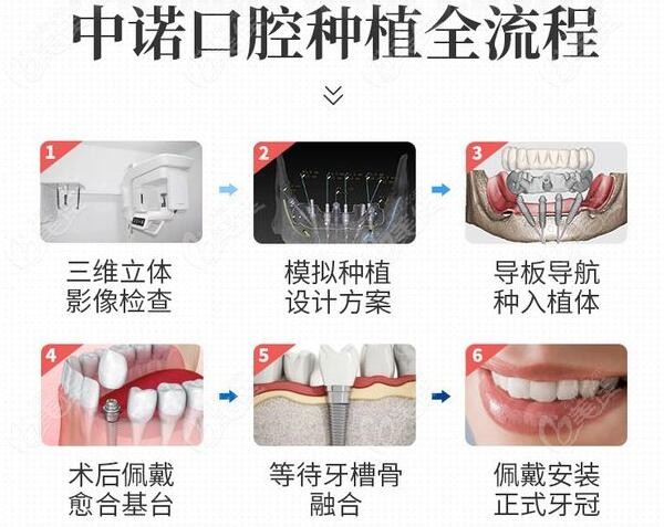 北京中诺口腔医院种植牙价格表