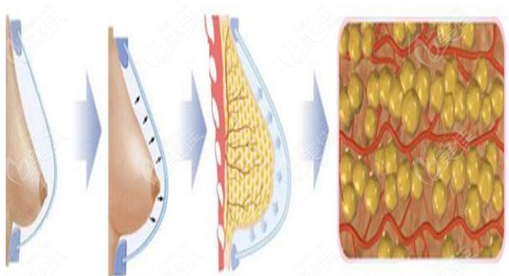 北京京美<!--<i data=20240703-sp></i>-->脂肪隆胸做得好，足以證明北京京美整形好m.236z.com 