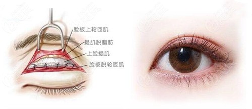 滕双艳做双眼皮好技术图解析