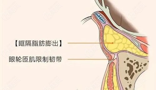 滕双艳去眼袋手术怎么样？做的好价格低