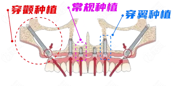 什么是穿颧穿翼种植牙技术