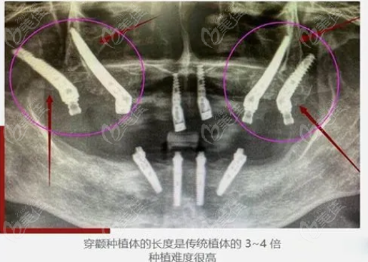 穿颧穿翼种植牙有什么风险和后遗症