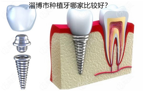 淄博市种植牙哪家比较好
