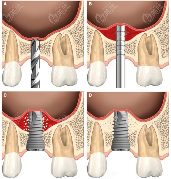 上颌窦提升种植牙过程图