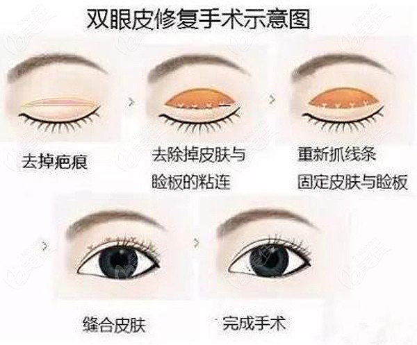 张会堂医生做双眼皮修复实例手术方案原理图