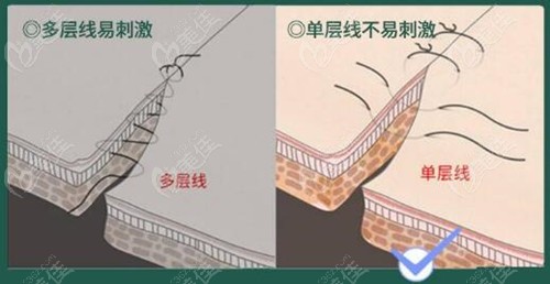 张会堂医生做眼修复的过程中会采用单层线缝合